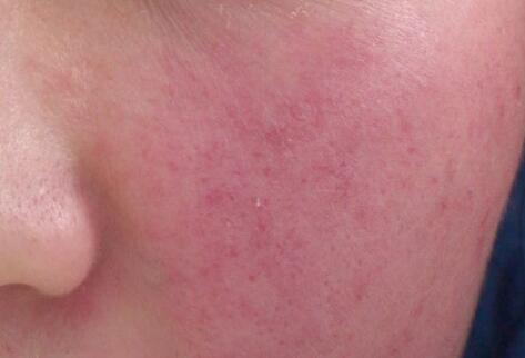 如何拯救你的敏感?。繌V西南寧美容培訓(xùn)叫你正確方法