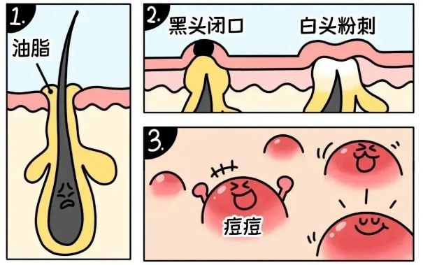 不同部位閉口形成的原因，南寧美容護(hù)膚學(xué)校解答
