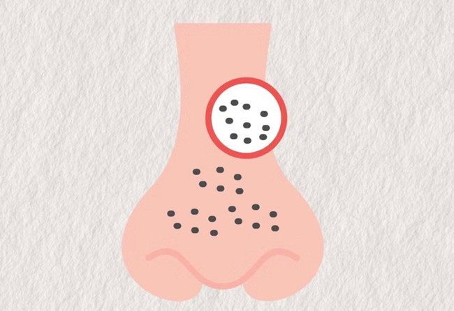 廣西皮膚管理師：面對(duì)嚴(yán)重的黑頭應(yīng)該怎么辦？